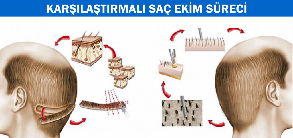 FUE saç ekimi nedir