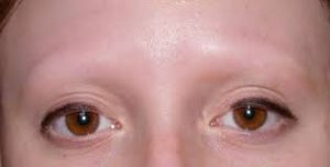 Kaş dökülmesinin sebepleri ve çözümleri